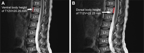 Figure 1 Measurement of ventral and dorsal ventral height was carried out at the T12 vertebra on T2-weighted sagittal MRI images in the control group. (A) Ventral body height of T12 vertebra. (B) Dorsal body height of T12 vertebra.