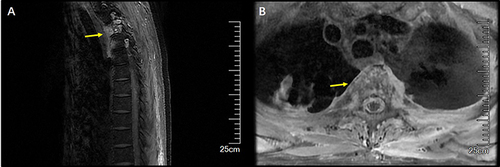 Figure 2 Thoracic vertebrae MRI, (A) sagittal plane and (B) coronal plane, indicate hyperintense signals in T3-T4 vertebral bodies and paravertebral tissue (Yellow arrows).