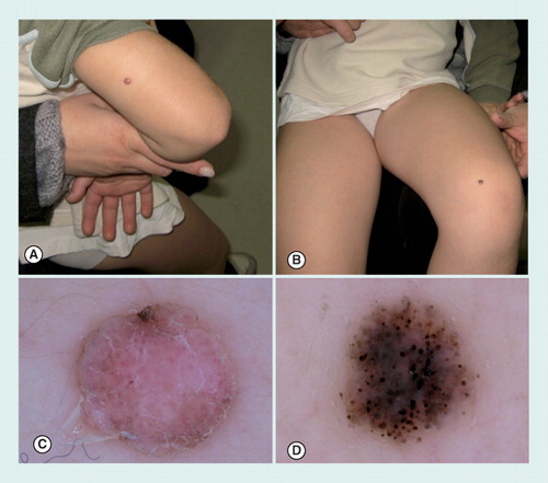Figure 6. Clinical images of a Spitz and Reed nevus.(A) A Spitz and (B) a Reed nevus arising, respectively, as a pink and black papule on the upper and lower arm of a 3-year-old boy. (C) Dermoscopy of nonpigmented Spitz nevus with dotted vessels and pinkish background. (D) Dermoscopy of Reed nevus, showing a globular pattern, composed by heavily pigmented brown-to-black globules.