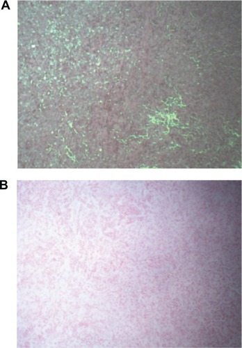Figure 6 Hematoxylin and eosin staining (A) and Prussian blue staining (B) of a PANC-1 nude mouse tumor electroporated 1.5 minutes after administration of iron nanoparticles.