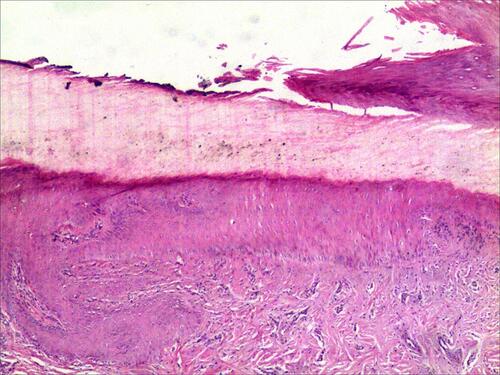 Figure 2 Histopathologic examination finding pigmentation granules on the deck (Hematox ylin-eosin stain; original magnification, ×10.).