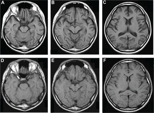 Figure 1 Transverse T1-weighted magnetic resonance images of the brain.