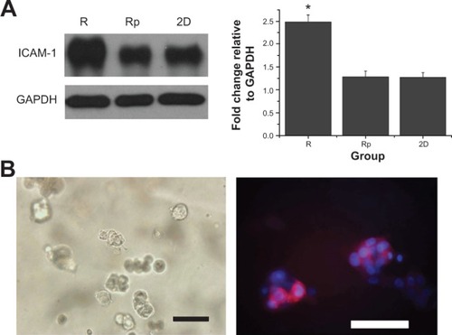 Figure 6 The reversion phenotype of MDA-MB-435S cells was inhibited by blocking NF-κB signaling by PDTC.Notes: (A) Western blot analysis of ICAM-1 of MDA-MB-435S cells in different culture groups. Equal amounts of protein were loaded per lane, and GAPDH was run as a control for equal loading and exposure time. The expression of ICAM-1 of cells in RADA16 was significantly downregulated by PDTC (*P<0.05). (B) Light microscope images and F-actin and nuclear fluorescence images of cells in PDTC-treated RADA16 group. Three-dimensional cultures were stained for F-actin, and nuclei were counterstained with DAPI. Scale bars represent 100 μm (left) and 50 μm (right).Abbreviations: 2D, two dimensional group; DAPI, 4′,6-diamidino-2-phenylindole, dihydrochloride; GAPDH, glyceraldehyde-3-phosphate dehydrogenase; ICAM-1, intercellular surface adhesion molecule-1; PDTC, pyrrolidine dithiocarbamate; R, RADA16 group; Rp, RADA16 + PDTC group; RADA16, COCH3-RADARADAR-ADARADA-CONH2.