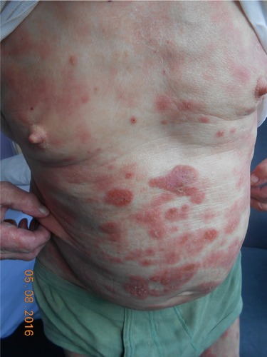 Figure 2 Mycosis fungoides “plaques” stage