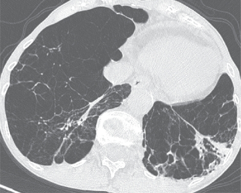 Figure 2 α1-Antitrypsin deficiency associated panlobular emphysema. There is a generalized decreased attenuation of the lung parenchyma and a striking paucity of pulmonary vasculature. Bronchiectasis are more prominent in the left lower lobe and coexist with patchy consolidation (probable infection). It is worth keeping in mind that panlobular emphysema shows an increased prevalence and extent of long lines in comparison to patients with obliterative bronchiolitis.