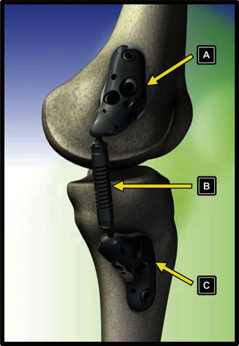 Figure 1 Components of the KineSpring® Knee Implant System. (A) femoral base, (B) absorber unit, (C) tibial base.