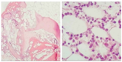 Figure 6. Bone marrow biopsy: HE and PAS staining showed that myeloid hyperplasia was normal (30–40%), small lymphocytes increased (40–50%), scattered and focal distribution, granulosa cells scattered in the mature stage, and the number of megakaryocytes was almost normal. Reticulated fiber staining (MF-2 grade, focal)