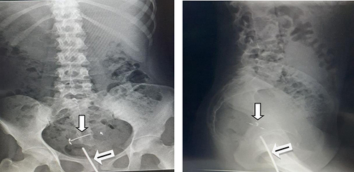Figure 1 Erect abdomino pelvic x-ray (AP & lateral) showing radio opaque T-shaped material and intrauterine probe in the pelvis.