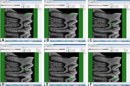 Figure 2 Measurement of the distances between (A) MMCJ and MRA, (B) MMCJ and MRA, (C) FR and FRCB, (D) FR and FRRA, (E) DMCJ and DCB, (F) DMCJ and DRA.