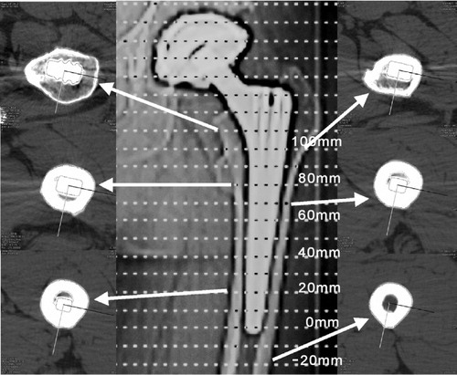 Figure 1.  Topogram of an uncemented prosthesis with a selection of CT scans. The first scan of the femur was done 2 cm below the tip of the stem (–20 mm) and the most proximal was done at the 100 mm position.