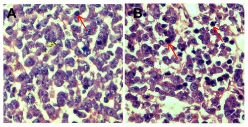 Figure 7 CNPs induce apoptosis in retinoblastoma cells. Retinoblastoma induced by inoculation with SO-Rb 50 cells were treated with blank micelles and CNPs at 27.2 mg/kg every other day for 3 weeks. Retinoblastoma tissue sections of (A) control and (B) CNP groups were stained with hematoxylin and eosin.Note: A greater number of cells showed a reduction in nuclear size, deeply stained nuclei, and condensed cytoplasm in the CNP group (red arrows show hyperchromatic nuclei).Abbreviation: CNPs, celastrol nanoparticles.