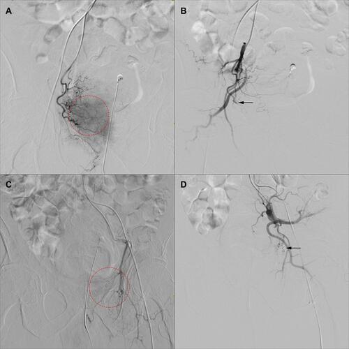 Figure 4 Imagines before and after superselective PAE. (A) DSA revealed extravasation of contrast medium from branches of the right prostatic artery before treatment (as circled in red). (B) PVA were injected into the right prostatic artery and the bleeding was significantly reduced (as indicated by the black arrow). (C) Before superselective PAE, DSA demonstrated that an obvious extravasation of contrast medium was arisen from the terminal branch of the left prostatic artery (as circled in red). (D) Because of the left vascular malformation, PVA, gelatin sponge and spring coil were injected into the left internal pudendal artery (as indicated by the black arrow), the prostatic parenchyma was not visible and the blood flow of prostatic artery was completely stopped.