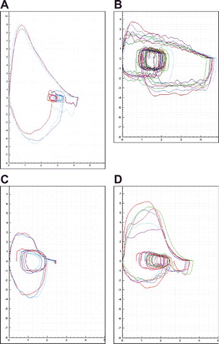 Figure 1. Examples of flow–volume curves categorized as (A) normal; (B) sawtooth; (C) low PEFR, reproducible; or (D) low PEFR, not reproducible. PEFR, peak expiratory flow rate.