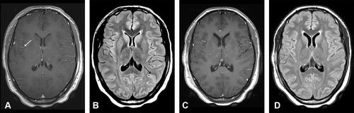 Figure 2 Axial magnetic resonance imaging (MRI) slice images of the brain: On admission: (A) T1-weighted contrast-enhanced (T1+C) and (B) axial fluid-attenuated inversion recovery (FLAIR) sequences illustrating contrast enhancement (white arrow) with sulcal hyper-intensity (black arrow) respectively; Day 15: (C) T1+C and (D) FLAIR sequences illustrating resolution of MRI abnormalities.