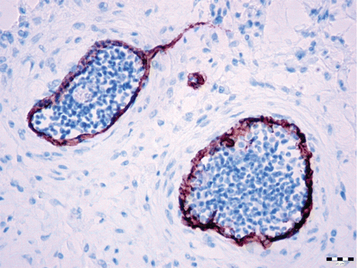 Figure 7. Claudin-5 membranous positivity (brown) in neoplastic endothelial cells of the angiolipoleiomyoma. Immunohistochemistry, diamino-benzidine–chromogen. Bar: 20 µm.