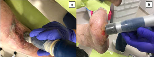 Figure 1 Example of a treatment session using radial ESWT for a VLU (A) and DFU (B).