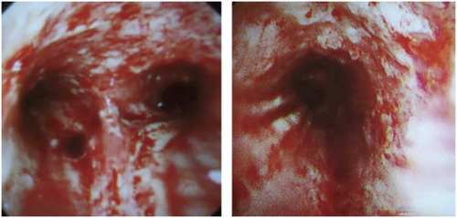 Figure 2 Bronchoscopy in Case 1 shows diffuse inflammatory changes and easy bleeding.