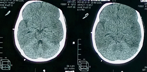 Figure 1 Computed Tomographic scan of the head in axial view demonstrates hypo-density of both brain hemispheres with loss of white-grey matter differentiation and the “White Cerebellum” sign in relation to hypoxic-ischemic lesions.