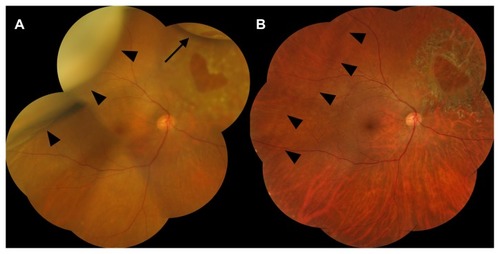 Figure 3 (A) Color fundus photograph of suprachoroidal gas. On postoperative Day 10, a large, temporo-superior choroidal elevation (arrowheads) is seen and the intravitreal gas (arrow) occupies <10% of the vitreous cavity. (B) The retina is attached, and 8 months later, the visual acuity is 20/20. The choroidal folds (arrowheads) persist long after the suprachoroidal gas has resolved.