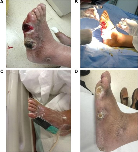 Figure 1 A male patient aged 62 years with subcutaneous abscess on the right side of the foot for 1 month; lateral ulcer, dry scab and nonunion for 2 months; and bipedal swelling and pain for 1 month.