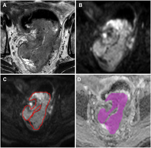 Figure 2 An example of manual segmentation of primary tumor on rectal cancer magnetic resonance imaging. (A) Maximum cross-section of primary tumor on T2-weighted (T2W) image in a T3 stage rectal cancer patient. (B) Maximum cross-section of primary tumor on diffusion-weighted (DW) image in the same patient. (C) Regions of interest were outlined directly along the margin of the whole tumor on maximum cross-section of the DW images, excluding the intraluminal gas, obvious necrosis and cystic areas using T2W imaging sequence as a reference standard (red region). (D) Copy of delineated area on the corresponding apparent diffusion coefficient map (magenta region).