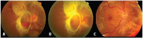 Figure 1 Fundus photographs of a case in group 2. A before injection of bevacizumab showing vitreous and subhyaloid hemorrhage and tractional retinal detachment. B 1 week after injection of bevacizumab showing evident regression of retinal neovascularization and C 12 months after vitrectomy with retina attached with near confluent laser marks.
