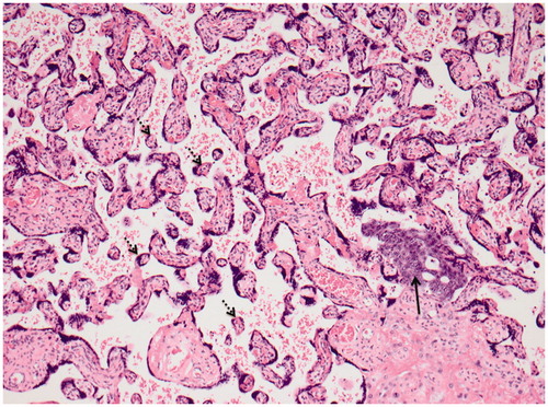 Figure 2. Placental tissue with distal villous hypoplasia showing small hypermature chorionic villi with increased syncytial knots (stipled arrows) in a widened intervillous space containing a group of tumor cells (black arrow) from the patient’s lung carcinoma (HE ×100).