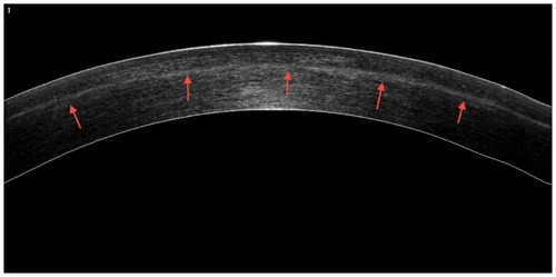 Figure 7 Anterior segment OCT image of a treated cornea.