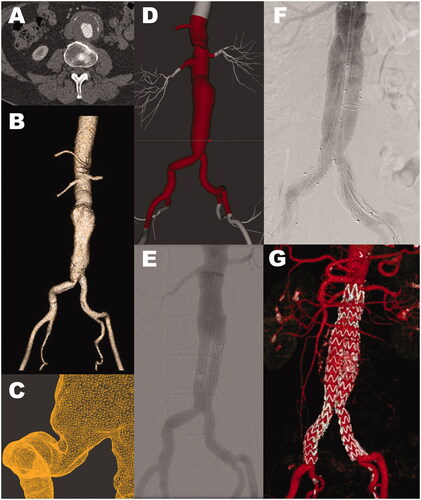 Figure 2. Patient with aneurysmal dilatation of the abdominal aorta, male, age 65. (A) Computed tomography angiography shows an aneurysm with a maximal diameter of 65 mm. (B) Segmented surface-rendered 3D reconstruction. (C) Detail from the STL model of the aortic bifurcation and the right common iliac artery. (D) The imported STL model (center) in the simulator stitched to the simulator template (light gray). (E) Angiogram of the stentgraft components on the simulator. (F) Angiogram of the stentgraft components in the patient. Visually E and F show good correlation. (G) CT-angiogram at six months follow-up.