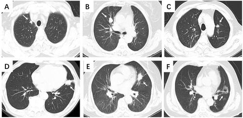 Figure 2. Diagram of the relationship between tumors (white arrows) and mediastinum. (A) Stellate tumor (white arrow) directly invading the great vessels (0 mm). (B) A round tumor adjacent to the great vessels (1–5 mm). (C) A round tumor near the great vessels (5–10 mm). (D) A round tumor directly invading the pericardium (0 mm). (E) Round tumor adjacent to the pericardium (1–5 mm). (F) Ground-glass nodule near the pericardium (5–10 mm).