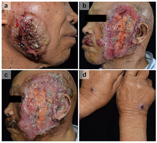 Figure 1 (a–c) Rapidly progressive painful ulcer (d) Positive pathergy test.