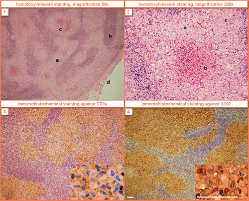 Figure 1. Histological findings of LCH in the right supraclavicular lymph node of Case 6. (1) The node is extensively infiltrated by coalescent, focally necrotized infiltrates with prevailing sinusoidal distribution (a – LCH infiltrates, b – lymph node tissue, c – necrotic foci, d – lymph node capsule). (2) The lesional cells have bland lobular nuclei frequently with indentations and abundant cytoplasm (a – Langerhans cells with reactive eosinophils, b – eosinophilic abscess with necrosis, c – giant multinucleated cells). The immunohistochemical staining causes brown membrane (3) and brown nuclear and cytoplasmatic (4) colorings. White scale line = 50 μm.