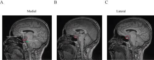 Figure 4. Sagittal spread pattern of intrathecal drugs. (A) Medial section of prepontine cisterna, and contrast spread ventrally in the lateral sections of subarachnoid cavity (B, C).