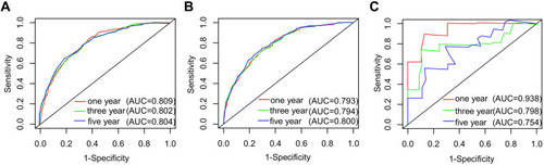 Figure 4 ROC curves for the nomogram’s prediction of 1-, 3-, and 5-year CSS in the training cohort (A), internal validation cohort (B), and external validation cohort (C).