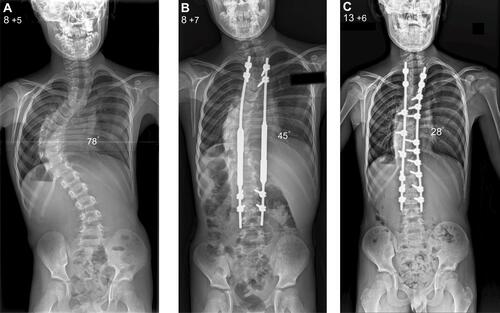 Figure 3 Male patient aged 8 years and 5 months with a progressive infantile idiopathic thoracic scoliosis (patient 2; (A). The patient was treated with the MAGEC and underwent consecutive lengthening at 3-month intervals as part of a clinical visit (B). At age 13 years he underwent the definitive posterior spinal fusion which achieved good coronal balance of the spine (C).