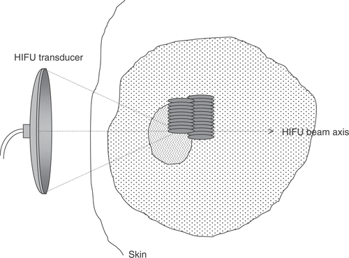 Figure 3. Diagrammatic illustration of HIFU treatment delivery for the ablation of large tissue volumes. Multiple lesions are created side-by-side to span the required treatment volume, starting on the side distal to the transducer. The lesions can be overlapping or separate, depending on the necessity to achieve confluent regions of cell killing.