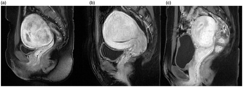 Figure 3. Contrast-enhanced types on T1WI. (a) Mild enhancement: the degree of enhancement was lower than the myometrium. (b) Moderate enhancement: the degree of enhancement was similar to the myometrium. (c) Significant enhancement: the degree of enhancement was higher than the myometrium.