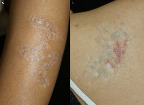 Figure 4 (A) Black tattoo (Fitzpatrick skin type IV) with permanent depigmentation after multiple sessions of Q-switch neodymium-doped yttrium aluminum garnet (1064 nm), (B) Multicolor tattoo (Fitzpatrick skin type III) with permanent depigmentation after multiple sessions of Q-switch alexandrite (755 nm) for green tattoo and Q-switch neodymium-doped yttrium aluminum garnet (532 nm) for red tattoo.
