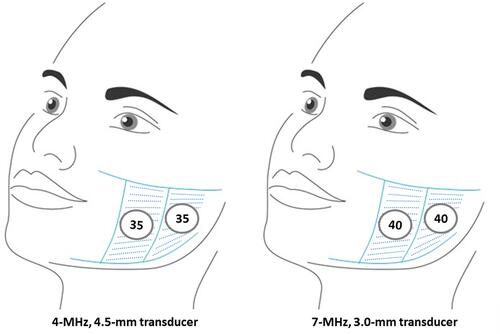 Figure 1 First area delimited by two vertical zones: anterior and posterior. Note the distance of 2.5 cm between the anterior line and oral commissure (security area). The inclination of the transducer was oriented to perform the contraction in direction to the tragus.