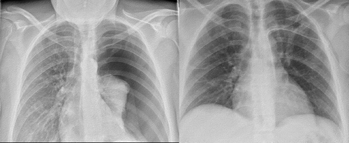 Figure 2. Initial chest x-ray with a left-sided pneumothorax (on the left) and a subsequent chest x-ray after placement of the tube (on the right).