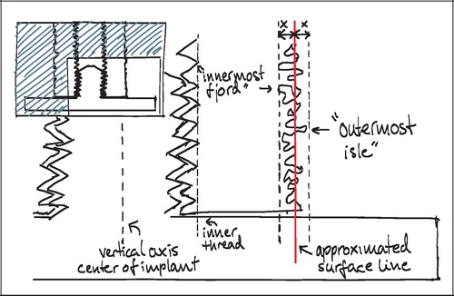 Figure 11. ROI reference line (”approximated surface line”) for placement of Zones 1 and 2