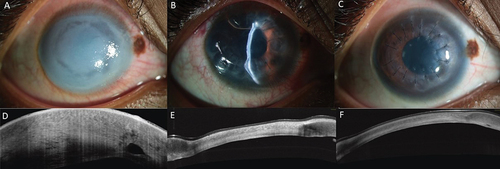 Figure 4. (a-f)- a: Slit-lamp photograph of the right eye when patient presented with a two-week history of increasing hydrops following blunt injury. The mid peripheral cornea shows circular area of differential transparency corresponding to posterior membrane dehiscence; b: Slit-lamp photograph of the right eye on first postoperative day shows remarkable resolution of corneal edema; c: Slit-lamp photograph at 1-week postoperative period shows improvement in corneal clarity; d-f: The corresponding optical coherence tomography pictures at pre-op, day 1 and 1 week are shown in d, e, and f, respectively.