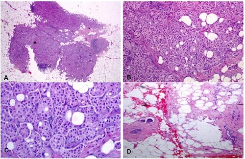 Figure 1 (A–D) In low magnification, through an atrophic mammary gland a neoplastic population is recognized, infiltrating the remaining ducts (A). The cells are organized in clusters, forming small-sized glandular structures and nests, arranged in a micropapillary pattern (B). Occasionally, a small proportion of them acquire a central lumina. Fibrovascular cores are absent. (C) The neoplastic cells have a moderate amount of eosinophilic cytoplasm and small round nuclei with condensed chromatin and intermediate pleomorphism. (D). In another slide of this lesion, a lymphovascular emboli is recognized (D). The morphology is highly suggestive of invasive micropapillary carcinoma, so immunohistochemical markers are performed to establish the diagnosis.