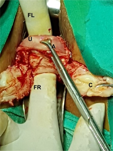 Figure 7 Alli’s forceps (A) pulling the upper incision margin of uterus (U) in downward direction. Index finger of left hand (anteriorly; FL) meets the index finger of right hand (posteriorly; FR) on back side of the mobilized posterior uterine wall. Cervix (C).