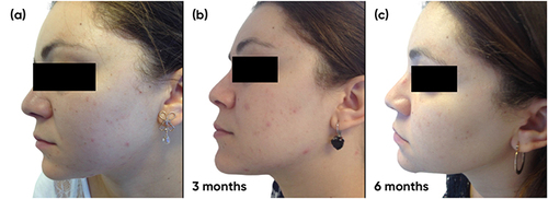 Figure 1 Case study 1 improvement on left-hand side of face, baseline to 6 months (a) Baseline (b) 3 months with AZA 15% gel twice daily (c) 6 months with AZA 15% gel twice daily.