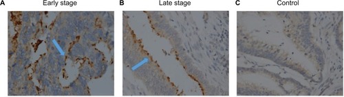 Figure 2 Immunohistochemistry staining for IL-17A.Notes: (A) A group of colonic adenocarcinoma showing strong positive epithelial neoplastic luminal staining for IL-17A in early-stage patient. (B) A group of colonic adenocarcinoma cells showing weak staining for IL-17A in late stage of colorectal cancer. (C) Photomicrograph showing normal nonneoplastic mucosa with negative staining for IL-17A. Arrows indicate positive staining. Magnification is 600×.