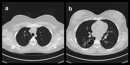 Figure 3. Transversal (A + B) high resolution computed tomography images showing conglomerates of cystic bronchiectasis in upper lobes and thick-walled and heterogeneous sized cysts in lower lobes