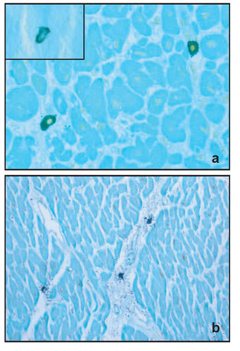 Figure 1 (a) Dual immunostaining of anti-tryptase and -chymase in the same mast cell located within the interior wall of right ventricle. The insert: Cardiac mast cell staining only with anti-tryptase, MCT. (b) Mast cell degranulation in the heart section of a drug victim. Original magnification × 400, in A and × 200 in b.