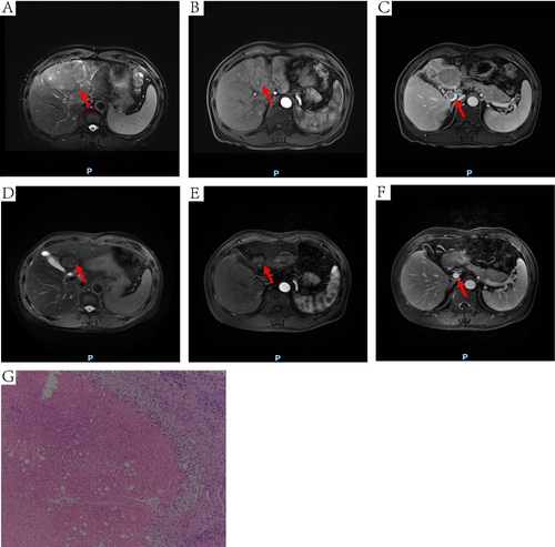 Figure 5 DCE-MRI and pathology of one HCC patient received conversion surgery. The red arrow points to the site of the tumor (A, B, D and E) or MPVTT (C and F). (A) an irregular mass on T2WI. (B) mass with heterogeneous enhancement at arterial phase. (C) MPVTT at venous phase. (D) the tumor was shrunken, the left lobe of the liver was atrophied on T2WI. (E) mass with absence of significant enhancement at arterial phase. (F) tumor thrombus in the MPV was disappeared at venous phase. (G) extensive necrotic tissue (HE, 100×).