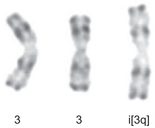 Figure 2 Partial karyotype showing +i(3q) -R-banding from patient with persistent polyclonal B-cell lymphocytosis.